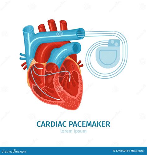 Heart Pacemaker Illustration Stock Illustration Illustration Of