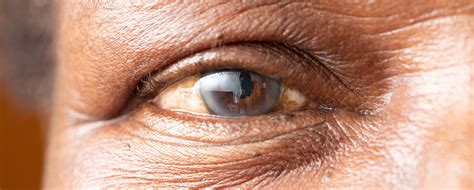 What Are Cataracts Vision Salon Eye Care Associates