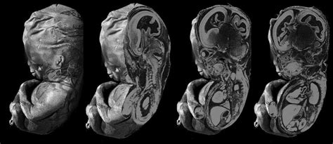 Fetal Postmortem Imaging An Overview Of Current Techniques And Future