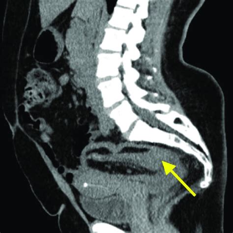 Computed Tomography Of The Abdomen And Pelvis Without Contrast Showing Download Scientific