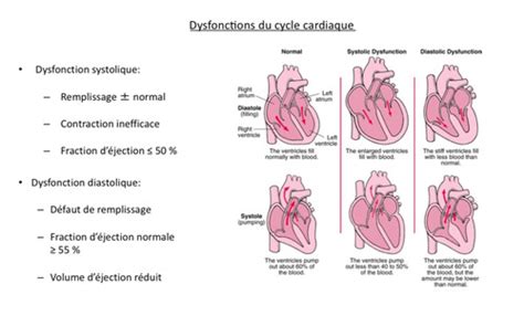 Insuffisance Cardiaque Flashcards Quizlet