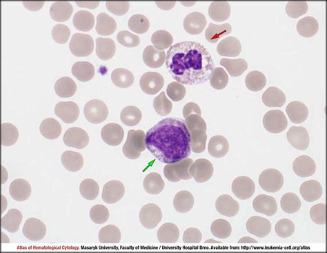 Atypical Chronic Myeloid Leukaemia ACML BCR ABL1 Negative CELL