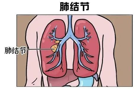 新冠康复体检安排了吗？查出肺结节怎么办？医生：不必惊慌防控知识天津市卫生健康委员会