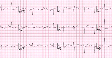 Dr Smiths Ecg Blog Head On Motor Vehicle Collision St Depression