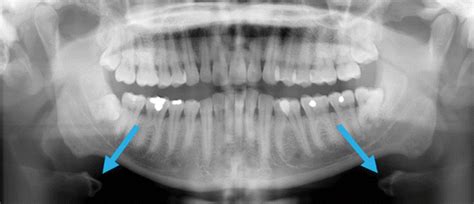 Pediatric Panoramic Radiography Techniques Artifacts And