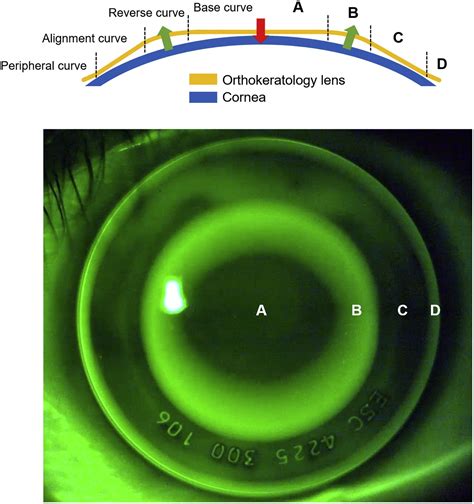 BCLA CLEAR - Orthokeratology - Contact Lens and Anterior Eye