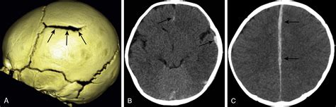 Abusive Head And Spinal Trauma Clinical Tree