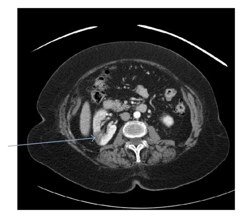 Right Kidney Infarction Blue Arrow Download Scientific Diagram