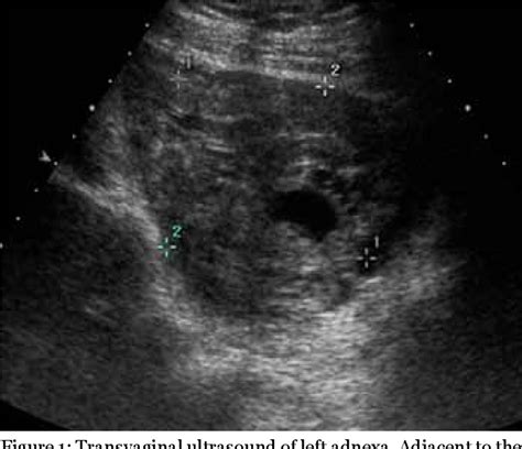 Figure From Massive Hemoperitoneum From A Ruptured Corpus Luteum Cyst