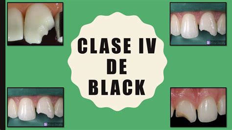 Clase De Black Iv Tati Dent Udocz