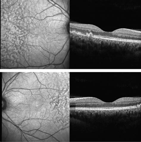 Case Report: Early-Onset Large Colloid Drusen - Retina Today