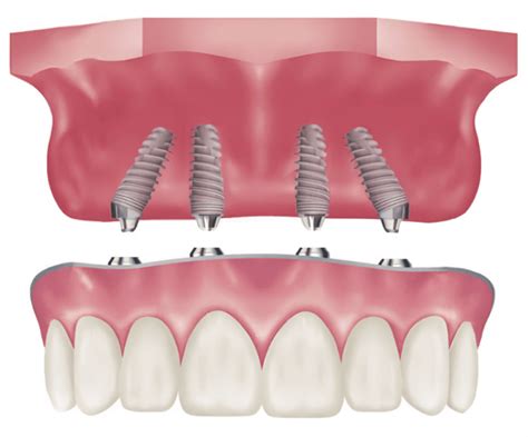 All On Implantes Odae Cl Nica Dental