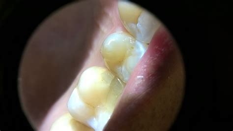 Upper 1st molar filling cracked. Should I crown or repair it? (pics in text) : Dentistry