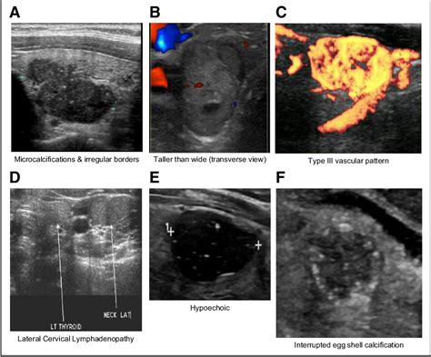 Figure 1 From Update On The Evaluation Of Thyroid Nodules Semantic