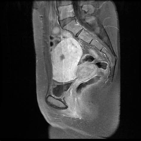 Uterine Leiomyoma Figo Type Vi Image