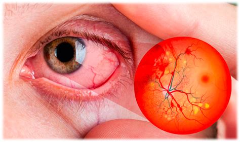 Retinopatía diabética en Mérida Oftalmólogo Especialista