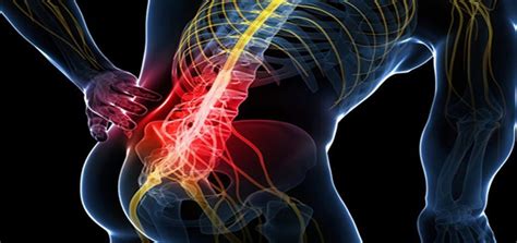 Sciatica Lower Back Pain | Dr Vicki Ferreira Chiropractor in Centurion