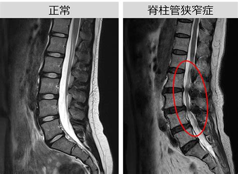 脊柱管狭窄症