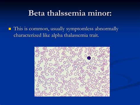 Ppt Thalassemia Powerpoint Presentation Free Download Id3295447