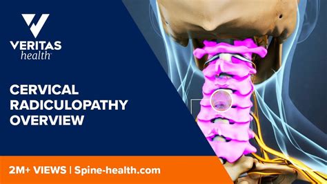 What Is Cervical Radiculopathy Dr Ronjon Paul