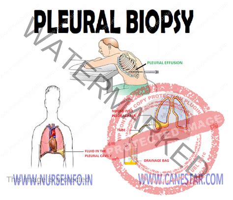 PLEURAL BIOPSY - Nurse Info