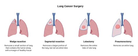 Lung Cancer Surgery with Description (Horizontal) | BioRender Science ...