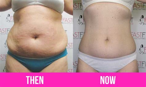 Surgical Vs Non Surgical Body Contouring Fast Fit Body Sculpting