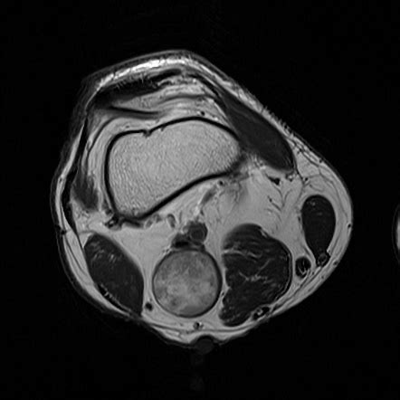 Tibial Nerve Mri