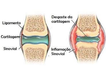 Como Reconstituir As Cartilagens Desgastadas Fisioterapia Oeiras