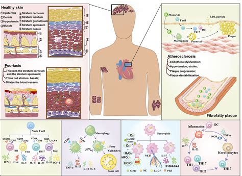 Frontiers | Immunity: Psoriasis comorbid with atherosclerosis