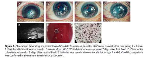 A Challenging Case Of Candida Parapsilosis Keratitis