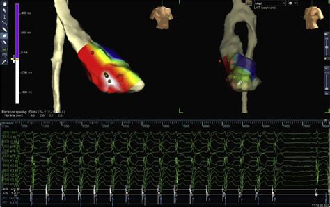 Tachycardia Termination On Ensite Velocity Rao On The Left Lao On The Download Scientific