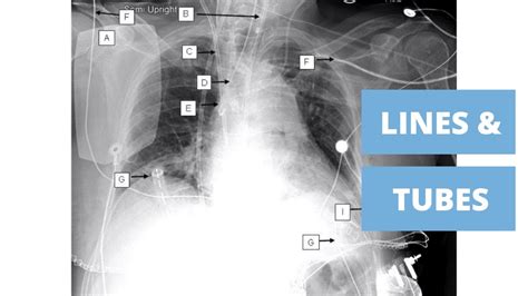 Beginners Guide To Lines And Tubes How To Read A Chest Xray YouTube