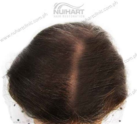 Nuhart4 Nuhart Hair Restoration Philippines