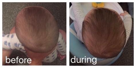 Plagiocephaly Before and After Treatment Pictures