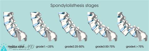 3d Illustration Spondylolisthesis Stages With Main Description