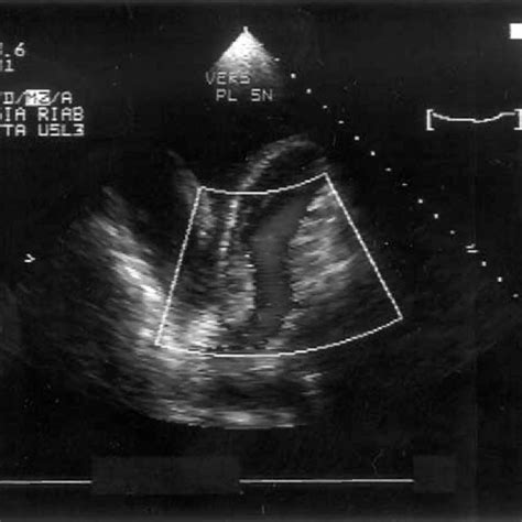 (PDF) Role of echocardiography after cardiac surgery during rehabilitation