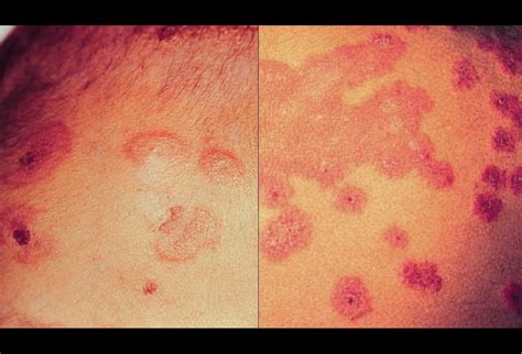 Erythema Conditions You Should Know