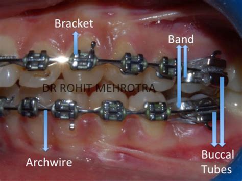 Types Of Orthodontic Appliances Fixed Appliance Invisalign Retainer Treatment In Mumbai