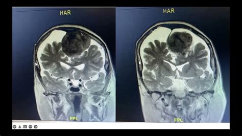 Reseccion De Meningioma Frontal Izquierdo Youtube