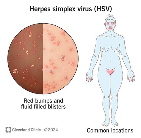 Oral herpes causes consequences treatment Sinta a empolgação das