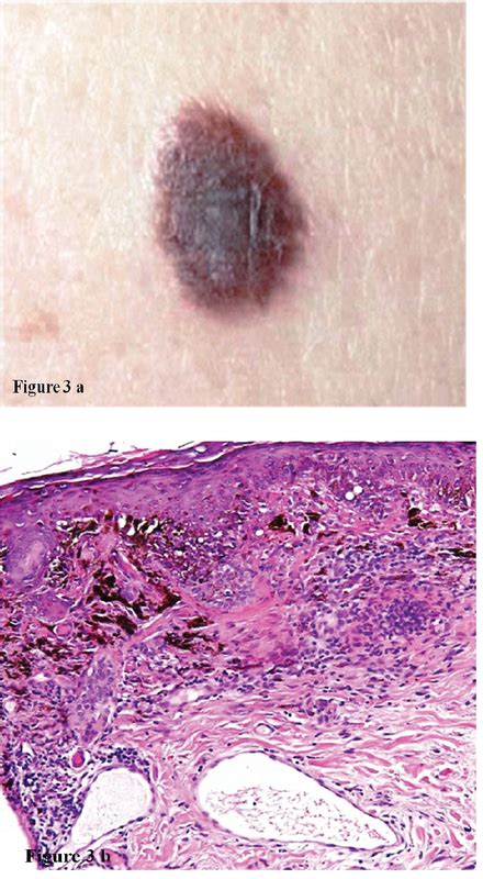 Junctional Melanocytic Nevus