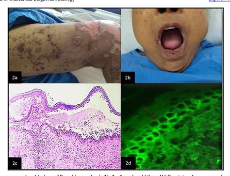 Figure From Clinicopathological Study Of Vesiculobullous Lesions Of