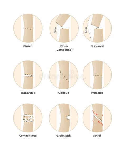 Fases Do Reparo Da Fratura De Osso Ilustração Do Vetor Ilustração De Ossos Osso 79043755