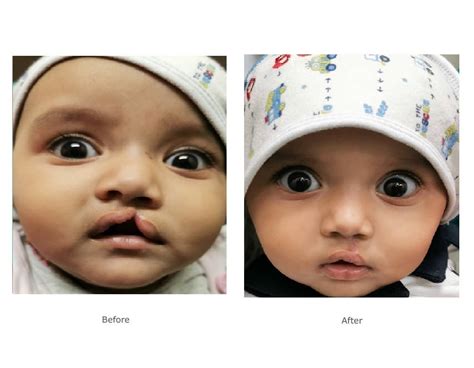 9 month old baby with birth defect of cleft lip and nose deformity. 2 ...