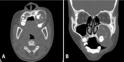 Calcifying Epithelial Odontogenic Tumor