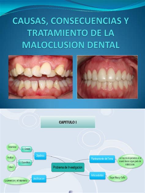 Causas Consecuencias Y Tratamiento De La Maloclusion Pdf Diente