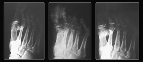 Distal Metatarsal Minimal Invasive Osteotomy (DMMO) for the ...