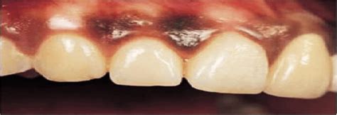 Lesiones Pigmentadas En La Cavidad Oral Dento Metric Radiolog A