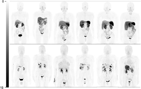 Head To Head Comparison Of 68Ga DOTA JR11 And 68Ga DOTATATE PET CT In